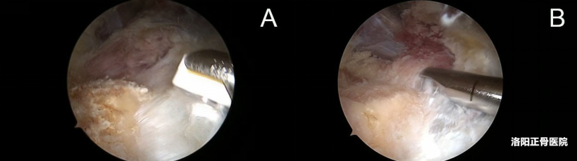 肘关节镜下“精准清理”治疗顽固性肱骨内上髁炎