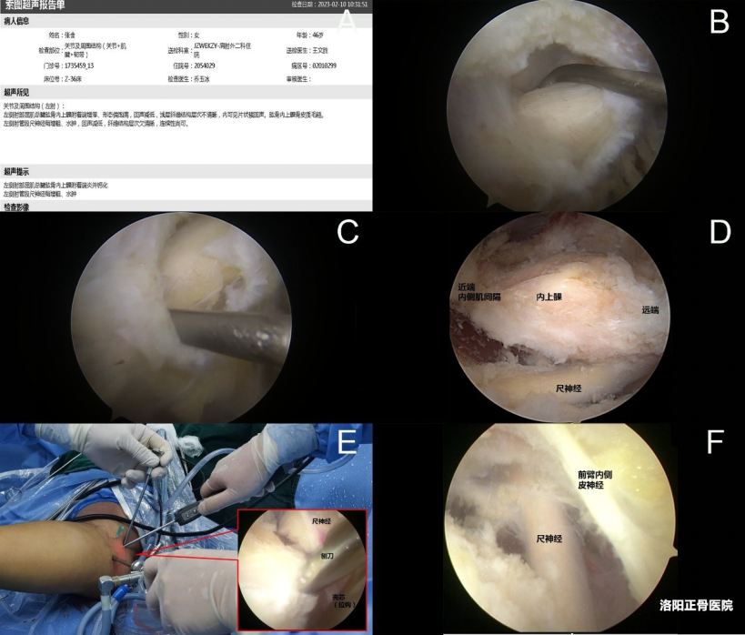肘关节镜下“精准清理”治疗顽固性肱骨内上髁炎