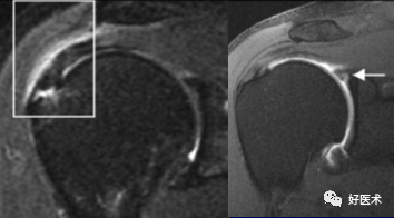 高清影像图解肩关节解剖及诊断
