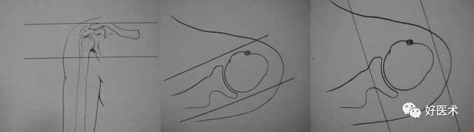 高清影像图解肩关节解剖及诊断