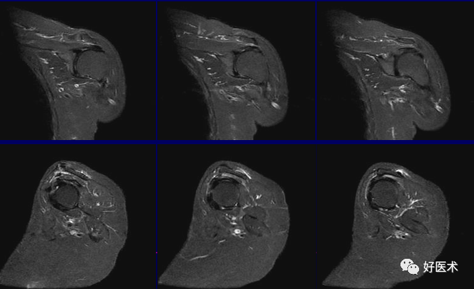 高清影像图解肩关节解剖及诊断