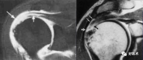 高清影像图解肩关节解剖及诊断