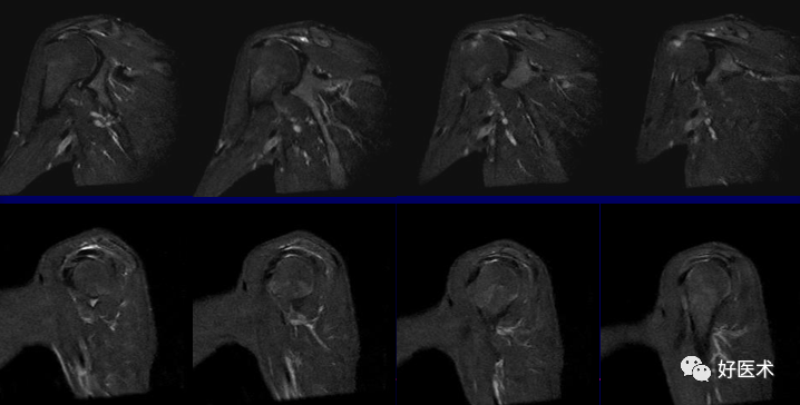 高清影像图解肩关节解剖及诊断
