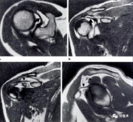 高清影像图解肩关节解剖及诊断