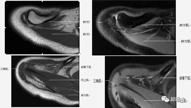 高清影像图解肩关节解剖及诊断