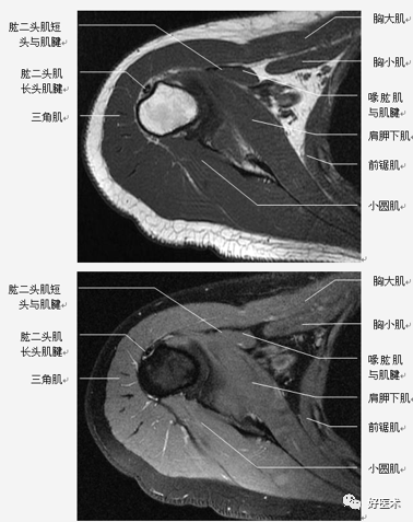 高清影像图解肩关节解剖及诊断