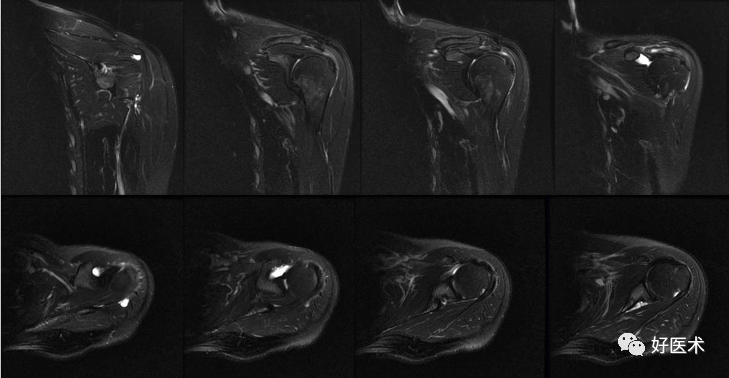 高清影像图解肩关节解剖及诊断