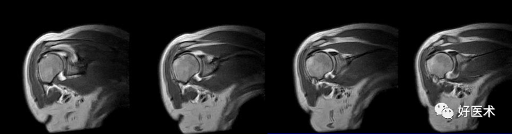 高清影像图解肩关节解剖及诊断