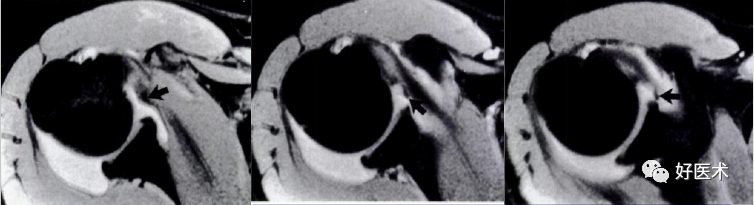 高清影像图解肩关节解剖及诊断