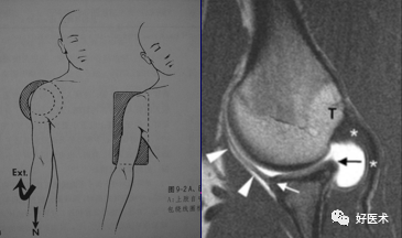 高清影像图解肩关节解剖及诊断