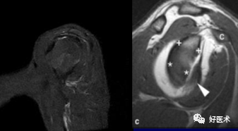 高清影像图解肩关节解剖及诊断