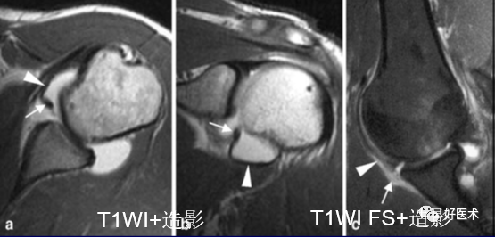 高清影像图解肩关节解剖及诊断