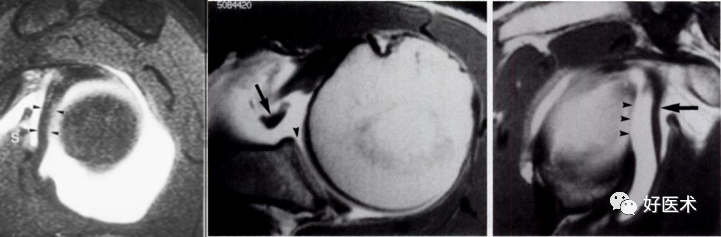 高清影像图解肩关节解剖及诊断
