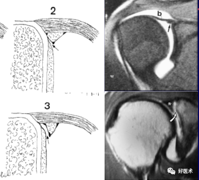 高清影像图解肩关节解剖及诊断