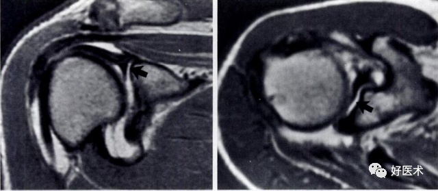 高清影像图解肩关节解剖及诊断