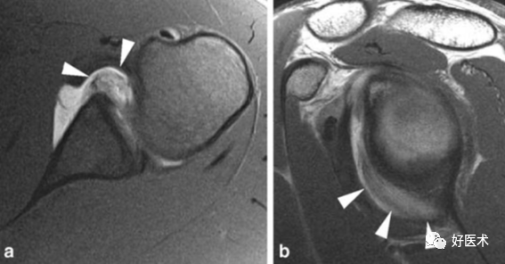 高清影像图解肩关节解剖及诊断
