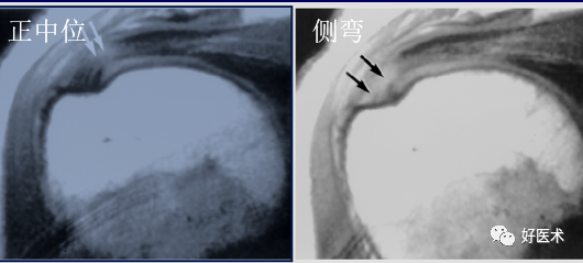 高清影像图解肩关节解剖及诊断