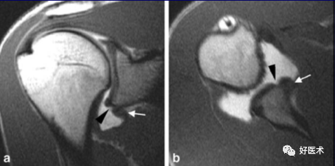 高清影像图解肩关节解剖及诊断