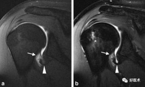 高清影像图解肩关节解剖及诊断