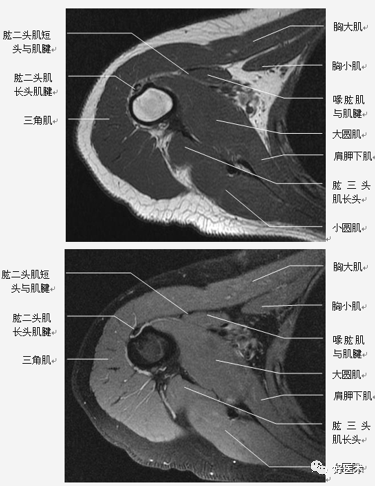 高清影像图解肩关节解剖及诊断