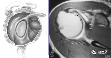 高清影像图解肩关节解剖及诊断