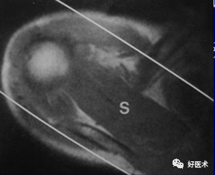 高清影像图解肩关节解剖及诊断
