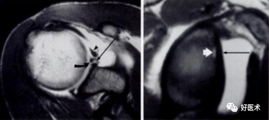 高清影像图解肩关节解剖及诊断