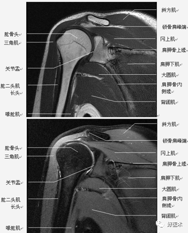 高清影像图解肩关节解剖及诊断