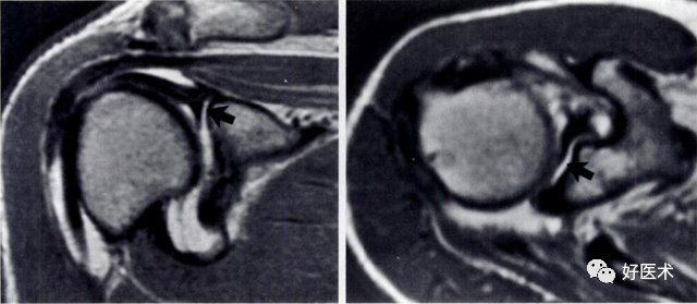 高清影像图解肩关节解剖及诊断