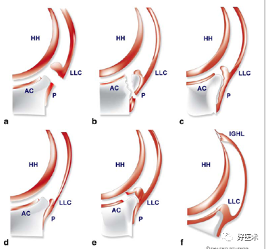 高清影像图解肩关节解剖及诊断