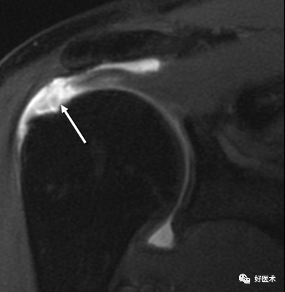 高清影像图解肩关节解剖及诊断