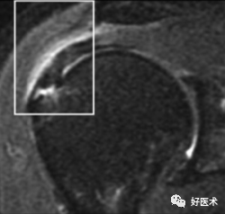 高清影像图解肩关节解剖及诊断