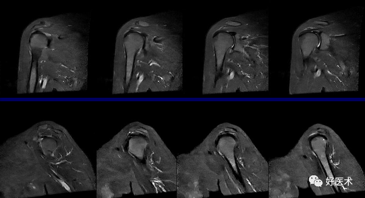 高清影像图解肩关节解剖及诊断