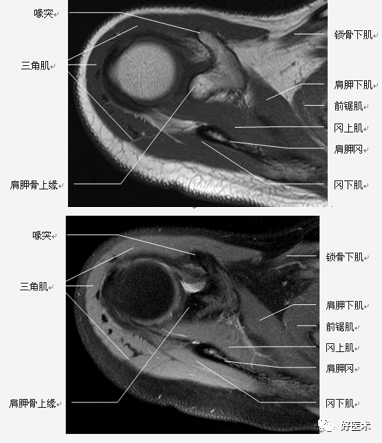 高清影像图解肩关节解剖及诊断