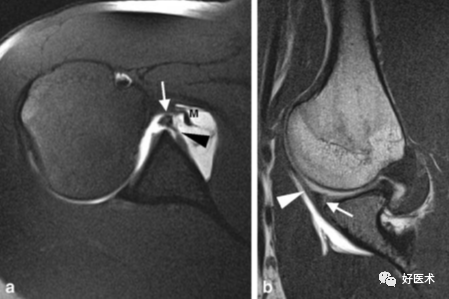 高清影像图解肩关节解剖及诊断