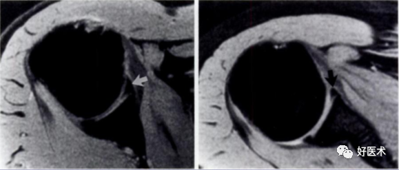 高清影像图解肩关节解剖及诊断