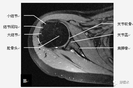 高清影像图解肩关节解剖及诊断