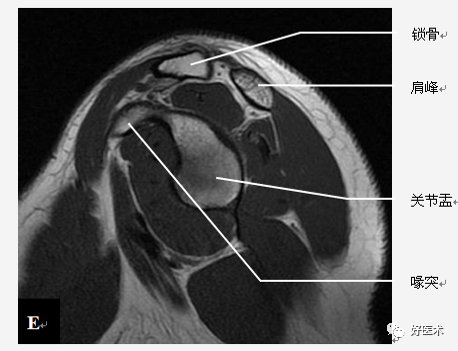 高清影像图解肩关节解剖及诊断