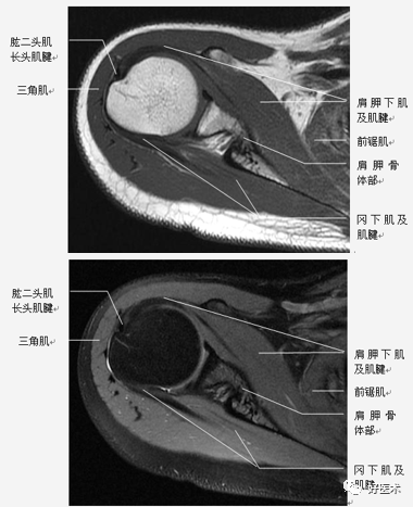 高清影像图解肩关节解剖及诊断