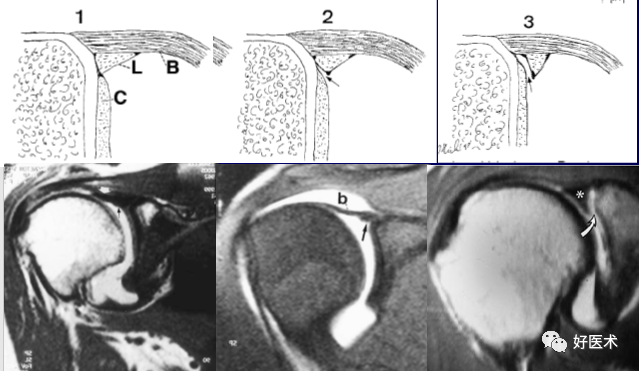 高清影像图解肩关节解剖及诊断