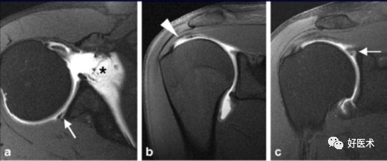 高清影像图解肩关节解剖及诊断