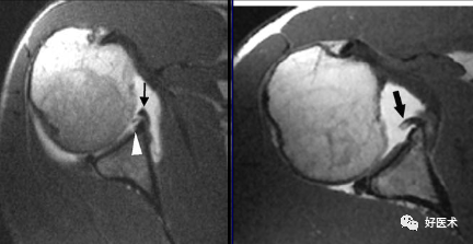 高清影像图解肩关节解剖及诊断