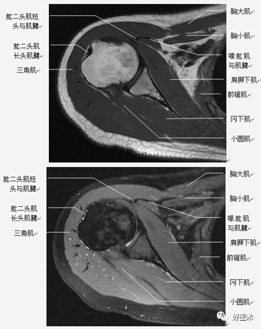 高清影像图解肩关节解剖及诊断