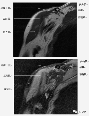 高清影像图解肩关节解剖及诊断