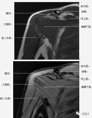 高清影像图解肩关节解剖及诊断
