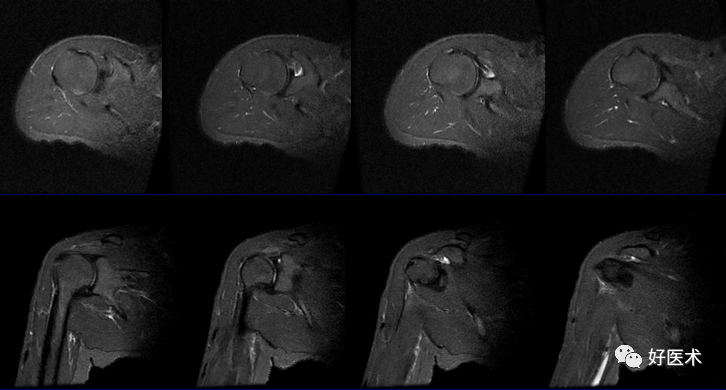 高清影像图解肩关节解剖及诊断
