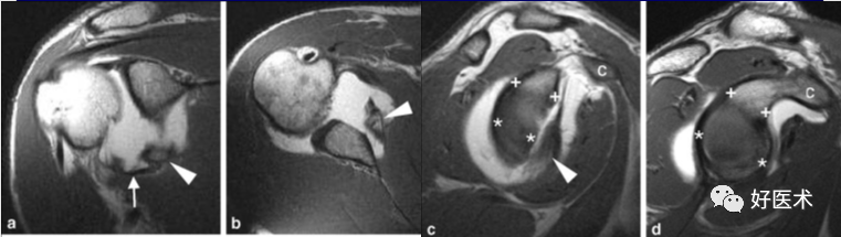 高清影像图解肩关节解剖及诊断