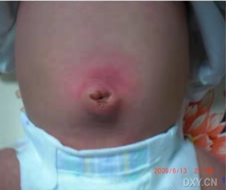 愈脐带怎么用视频断开生命的桥梁，爱依然在—谈谈新生儿脐部那些事_https://www.jmylbn.com_新闻资讯_第3张