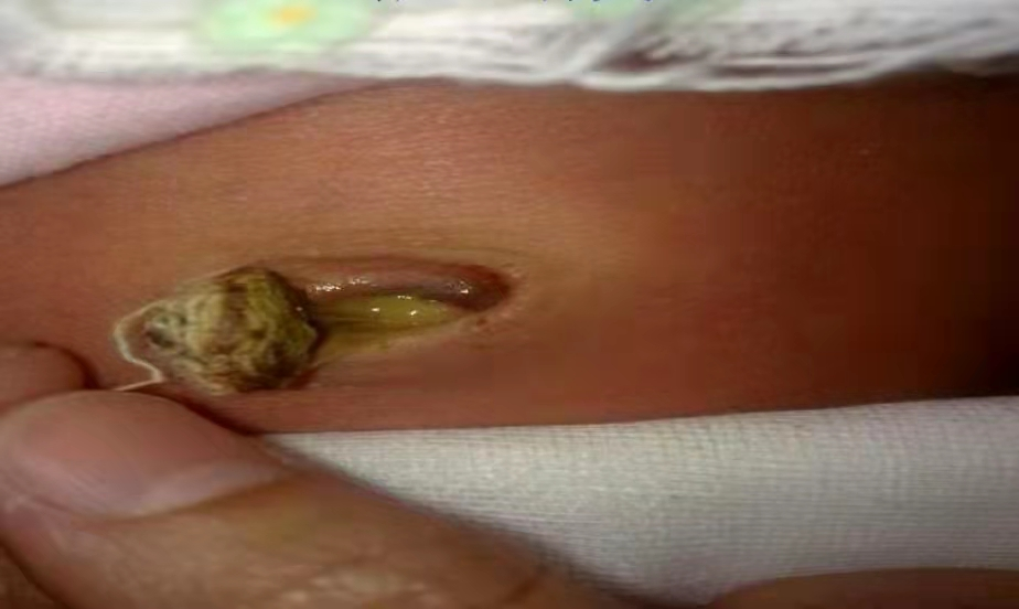 愈脐带怎么用视频断开生命的桥梁，爱依然在—谈谈新生儿脐部那些事_https://www.jmylbn.com_新闻资讯_第4张