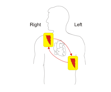 自动体外除颤器是什么【海关科普】自动体外除颤器_https://www.jmylbn.com_新闻资讯_第12张